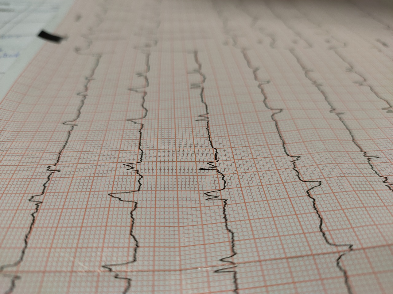 EKG